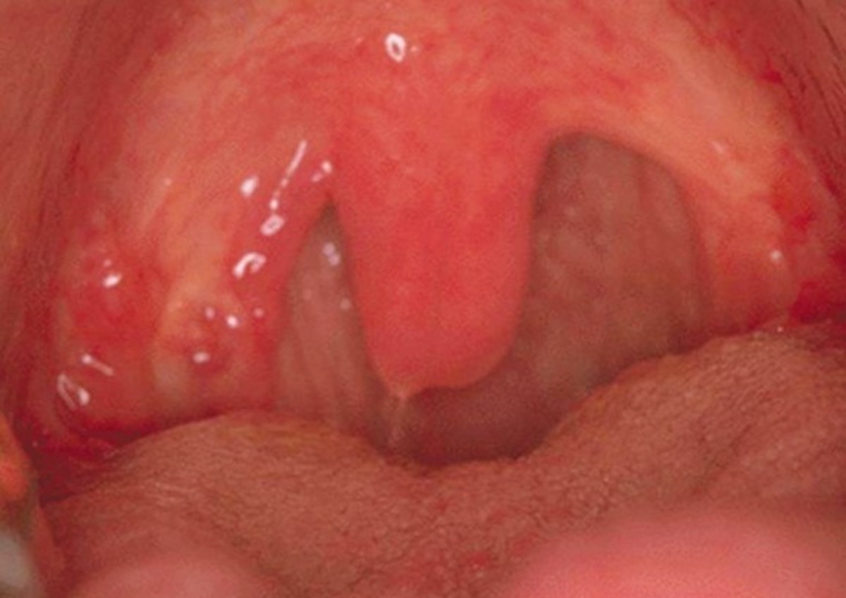 Throat Swollen Uvula 5