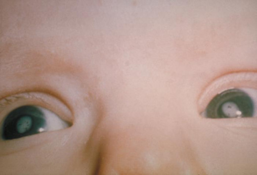 Bilateral cataracts in an infant due to congenital rubella syndrome