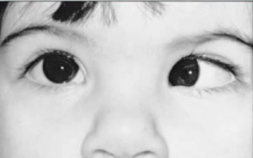 Syndrome Pictures, Life Expectancy, Symptoms