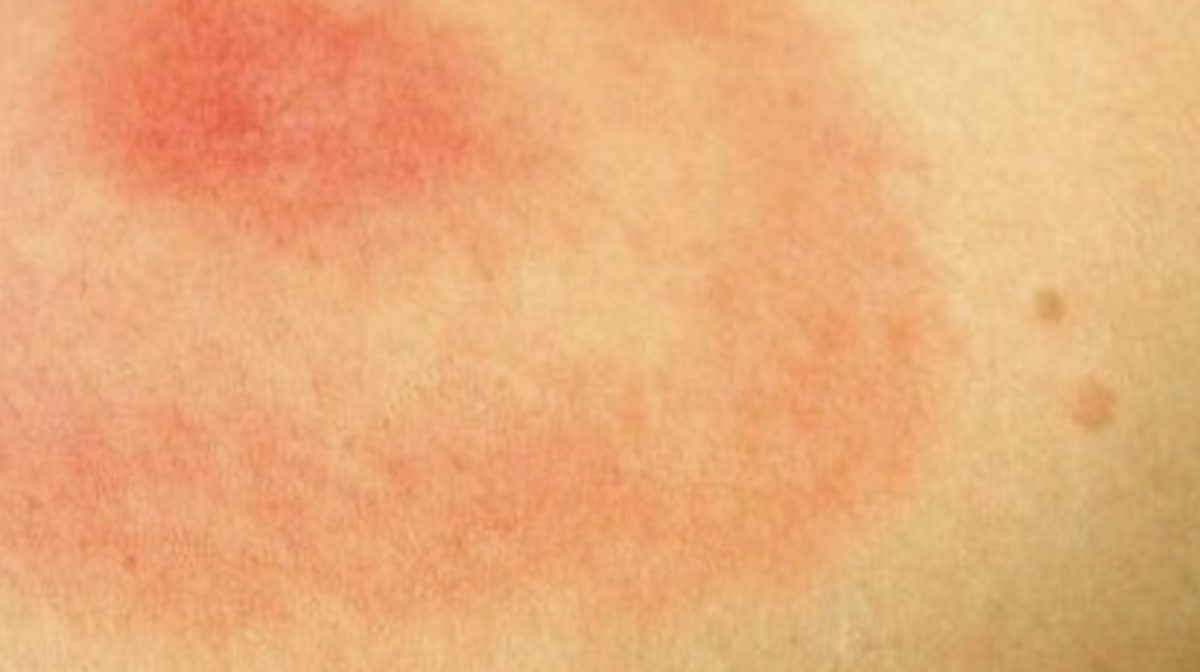Lyme Disease Rash Pictures Test Symptoms Causes Treatment Hubpages