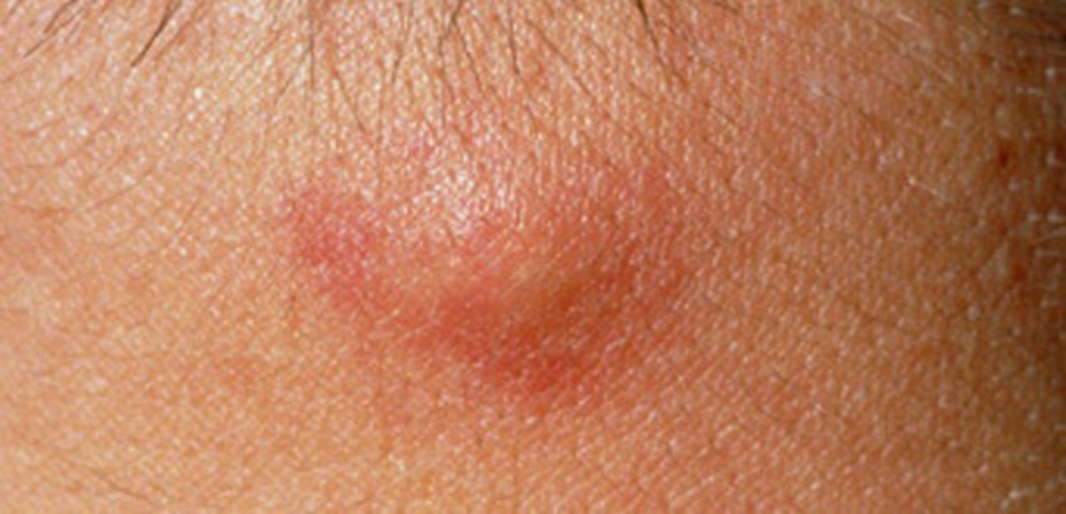 Skin Bumps And Lumps What Do They Mean Scripps Health