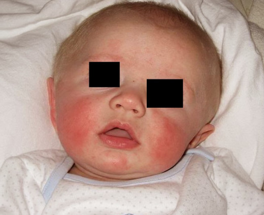Fifth Disease - Pictures, Symptoms, Treatment, Causes ...