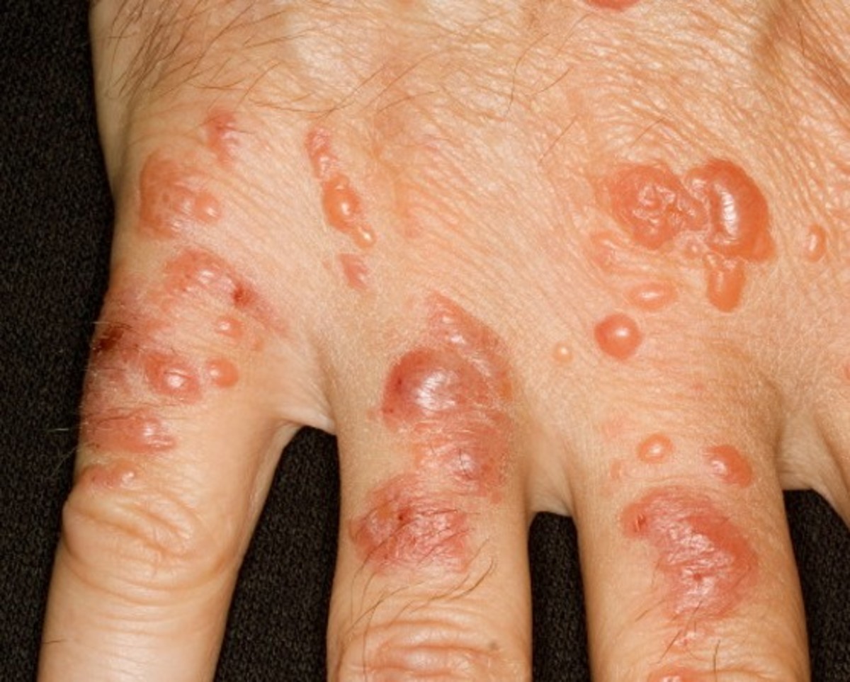 pictures of contact dermatitis