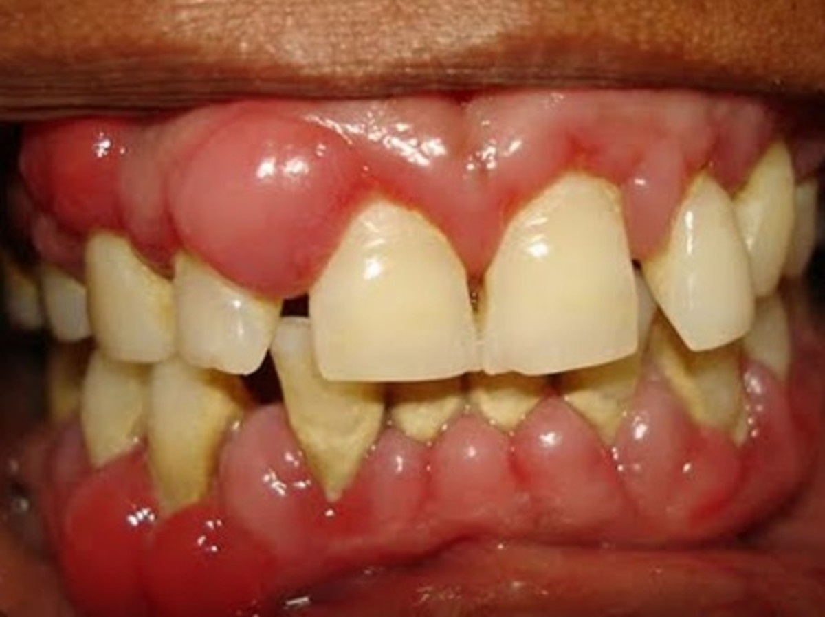 swollen gums after dentist visit