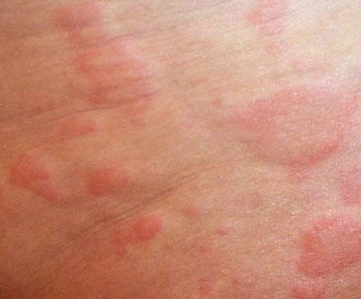 photos of different skin rashes