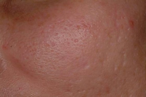 Popping zits leads to embarrassing scars and expensive treatments for them.