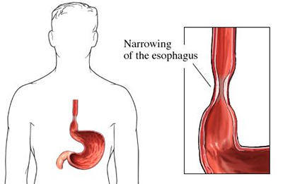 Narrowing of the esophagus