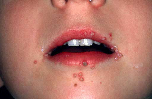 warts on face