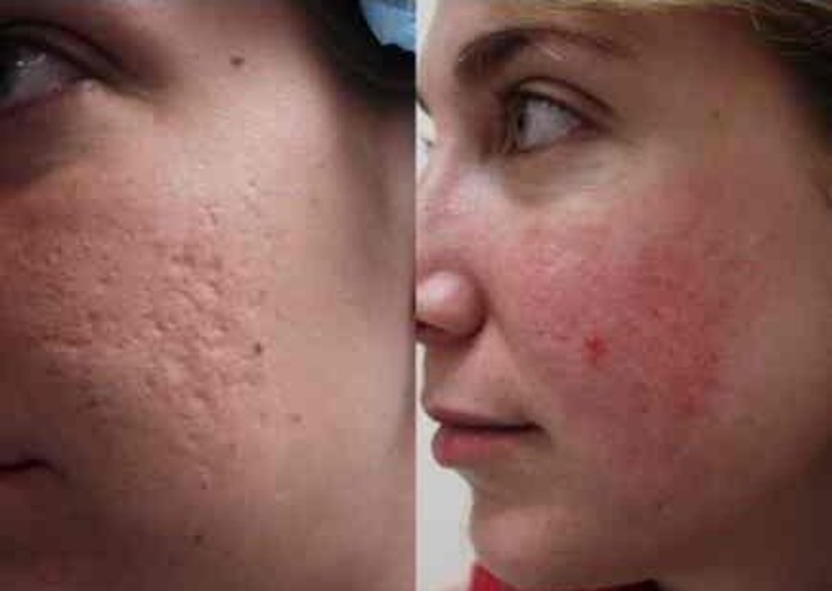Home Remedies to Remove Deep Acne Scars | Bellatory