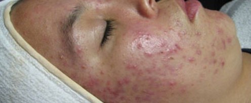 What Is Acne Vulgaris? | Bellatory