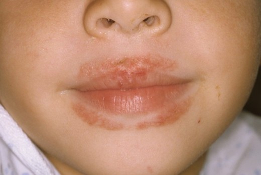 Facial Rash Around Mouth 37