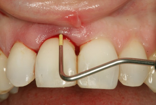 Infected Tooth - Extraction, Symptoms, Treatment, Causes, Pictures