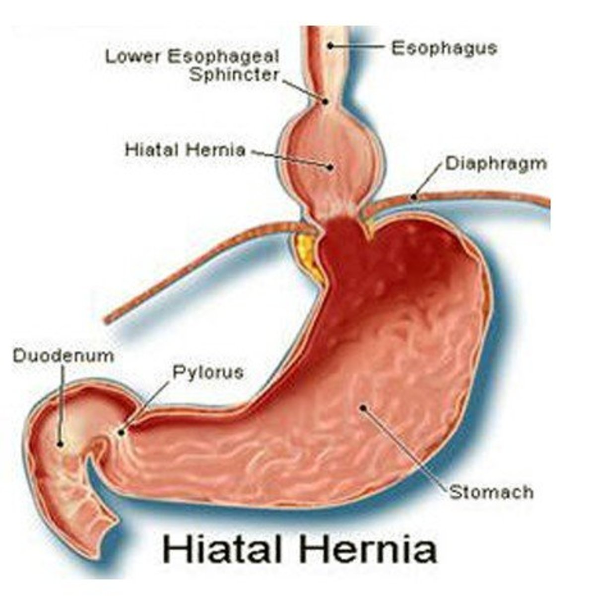 what is a hiatal hernia