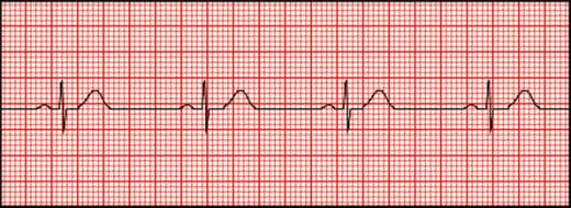 Sinus Bradycardia - Symptoms, Causes, Treatment | hubpages