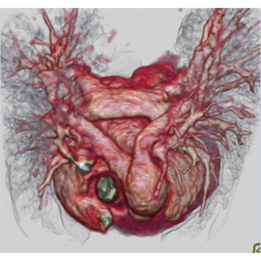 Congenital heart disease results from abnormal development of particular portions of the heart during embryonic development, eg defective development of the interventricular septum results in various type of ventricular septal defects