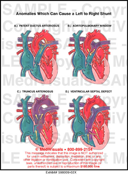 A pulmonic ystolic murmur may be heard. The murmur and the thrill are produced by increased blood flow through the pulmonary valve. 