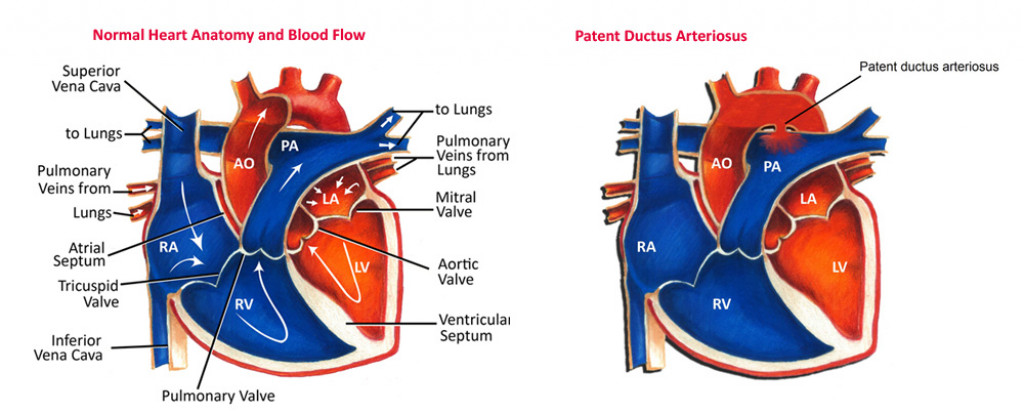 Left To Right Shunt Lesions: Patent Ductus Arteriosus (PDA ...