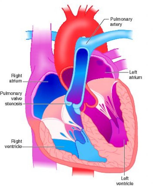 Acquired Lesions Of The Pulmonary Valve | hubpages