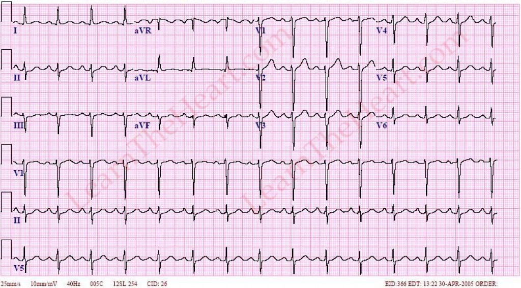 Clinical Manifestations, Diagnosis And Prognosis Of Heart Block