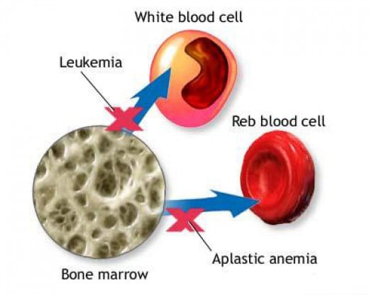 all-you-need-to-know-about-aplastic-anemia-or-bone-marrow-failure