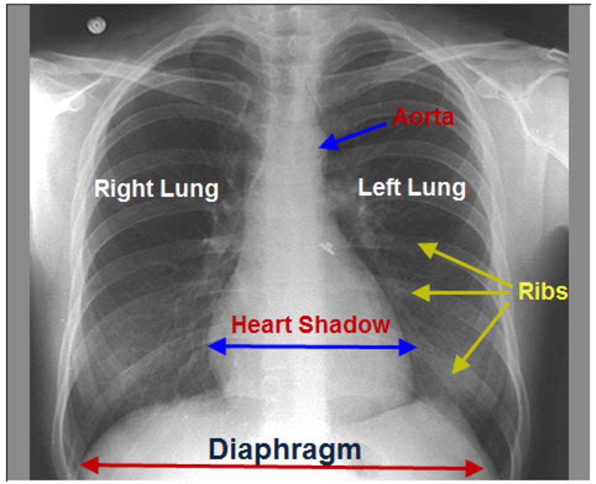Reading The Chest X Ray Chest Radiography Identifying A Normal Chest