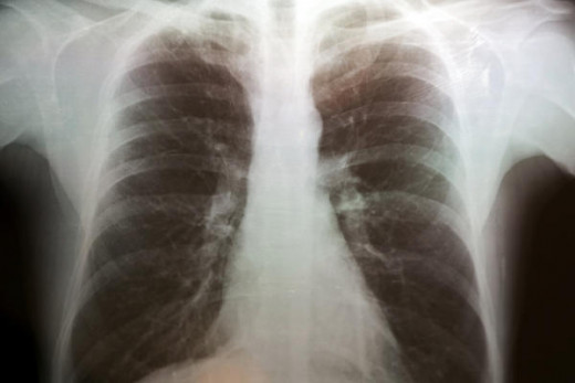 Emphysema. This lung disease causes destruction of the fragile walls and elastic fibers of the alveoli. Small airways collapse when you exhale, impairing airflow out of your lungs.