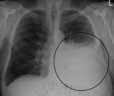 Normally, the pleural space, which is between the parietal and visceral pleurae, is only a potential space. Bleeding into the pleural space may result from either extrapleural or intrapleural injury. 