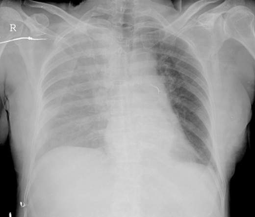 internal mammary arteries. In nontraumatic cases, rare disease processes within the chest wall (eg, bony exostoses) can be responsible. Blunt or penetrating injury involving virtually any intrathoracic structure can result in hemothorax.