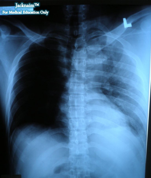 Pulmonary parenchymal injury is usually associated with pneumothorax and results in limited hemorrhage. Hemothorax resulting from metastatic malignant disease is usually from tumor implants that seed the pleural surfaces of the thorax. 