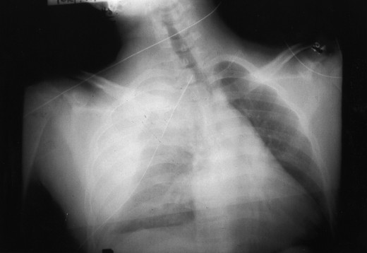 Hemothorax can result from a pathologic process within the abdomen if blood escaping from the lesion is able to traverse the diaphragm through one of the normal hiatal openings or a congenital or acquired opening. 