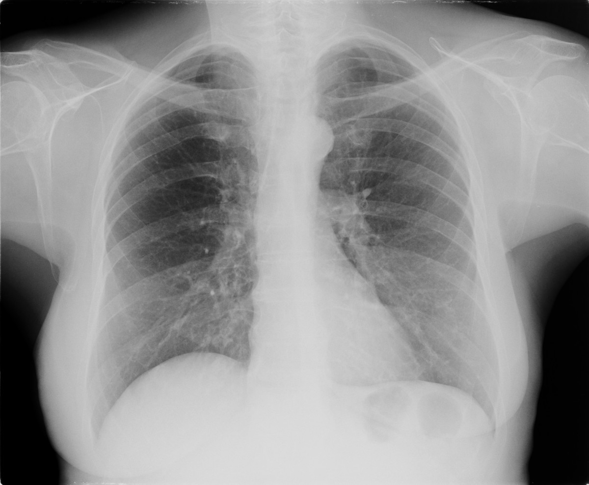 radiographic presentation of lung cancer