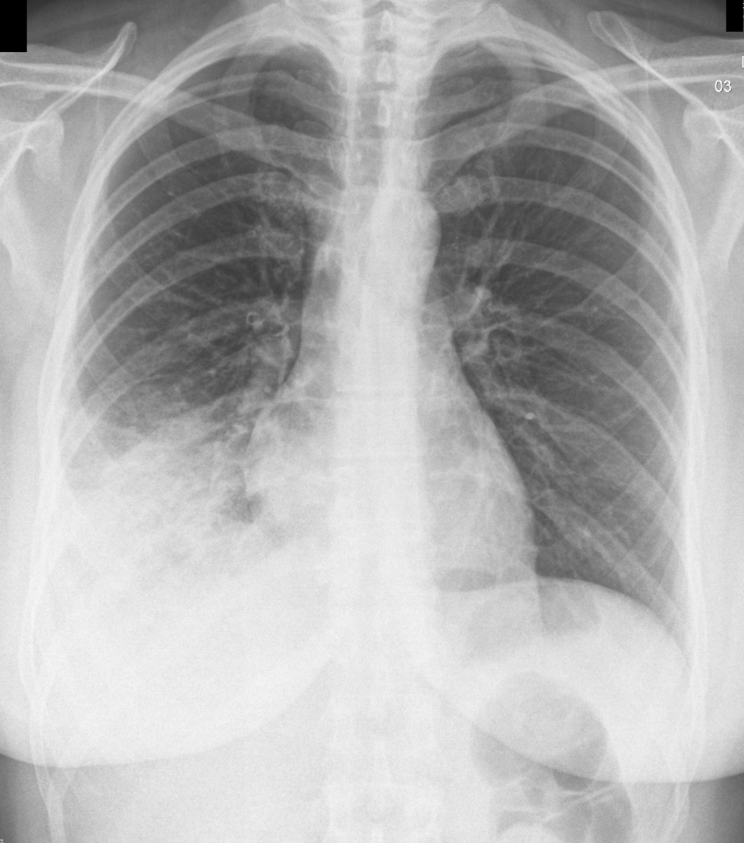Pneumonia Manifestation Seen And Diagnosed Via X