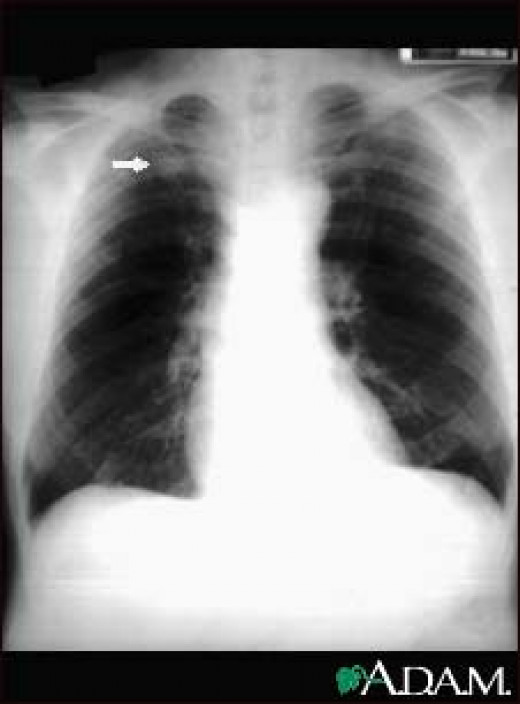Tuberculosis As Seen In Radiographs XRays Showing The Lungs Affection