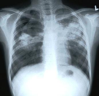 More people in the developing world contract tuberculosis because of compromised immunity, largely due to high rates of HIV infection and the corresponding development of AIDS.