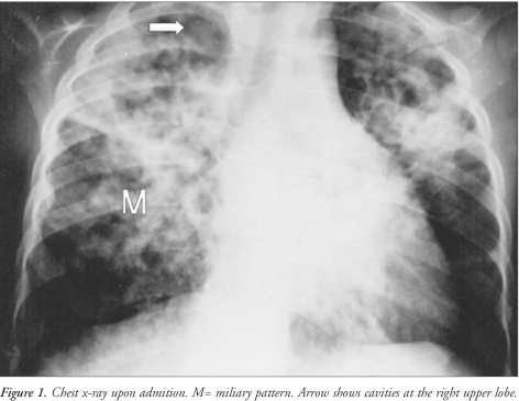 Extrapulmonary TB occurs when tuberculosis develops outside of the lungs, although extrapulmonary TB may coexist with pulmonary TB as well.