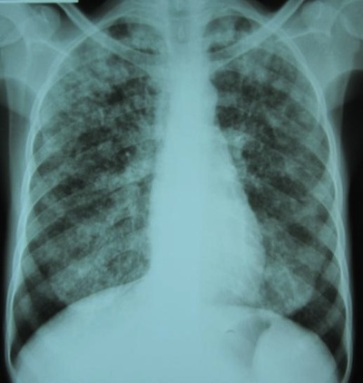 A definitive diagnosis of TB is made by identifying M. tuberculosis in a clinical sample (e.g. sputum, pus, or a tissue biopsy). However, the difficult culture process for this slow-growing organism can take two to six weeks for blood or sputum cultu