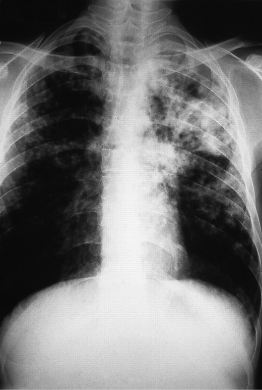 with estimates that it might account for more than 50% of reactivated cases in areas where TB is common. The chance of death from a case of tuberculosis is about 4% as of 2008, down from 8% in 1995