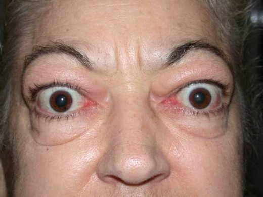 Exophthalmos and ophthalmoplegia may be present in thyrotoxicosis and pituitary tumours. Cattaract occurring prematurely may point to diabetes mellitus or hypoparathyroidism.