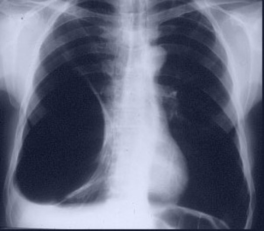 Emphysema Symptoms Causes Treatment Life Expectancy Pictures