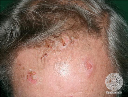 Pemphigus Vulgaris: Health Significance As A Skin Disease, Diagnosis ...