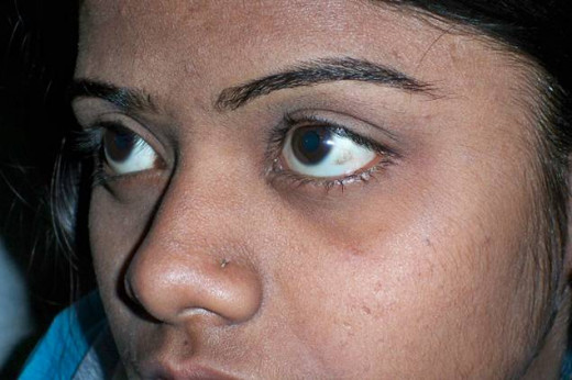 The earliest symptom is night blindness, followed by degenerative changes in the retina. The bulbar conjunctiva becomes dry, and rough grayish triangular foamy raised patches appear (Bitot’s spots).
