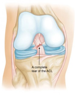 ACL reconstruction: Two weeks post Op