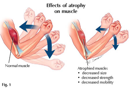 An example of muscle atrophy in the biceps, which is the same principle in all muscles.