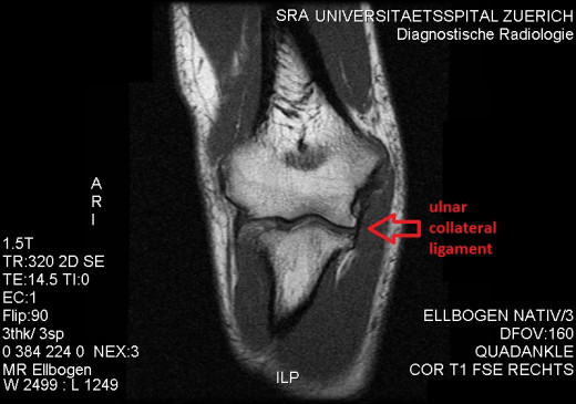 The elbow is made up of three main bones: the humerus, the ulna, and the radial. The ulnar collateral ligament (UCL) spans the humerus and attaches to the ulna. The UCL makes up three separate bands: then anterior oblique ligament, posterior oblique 