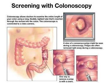 Colonoscopy screening
