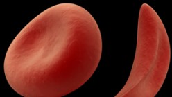 What is Sickle Cell Disease?