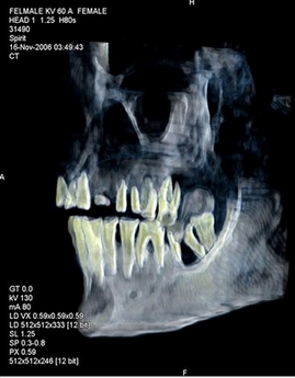 Queen Hatsheput's jaw xray