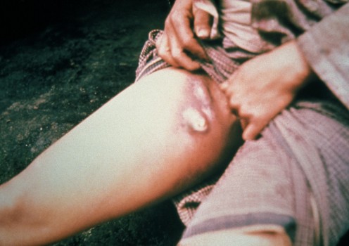 A plague patient in 1993 displaying a swollen, ruptured inguinal lymph node, or buboe, analogous to the symptoms described by many during the black death.