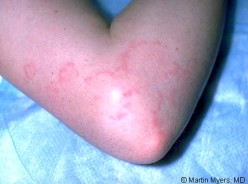 Acute Rheumatic Fever: Clinical Significance Of Its Diagnosis As A Streptococcal Infection