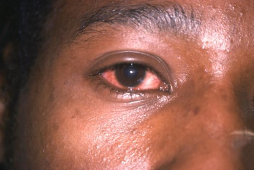 gonorrhea symptoms eye